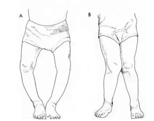 宝宝7个月就走路，担心以后O型腿？骨科医生教你3个方法自查