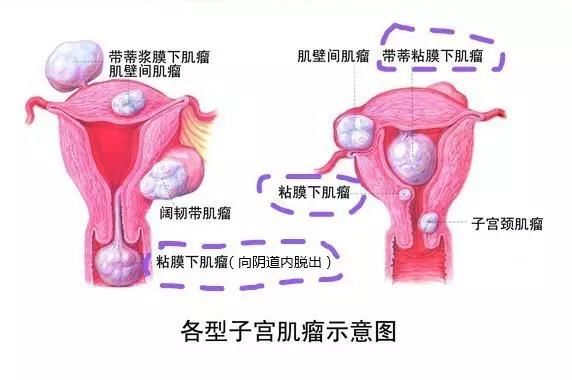 子宫异常出血的原因及注意事项,子宫异常出血和大姨妈有什么区别