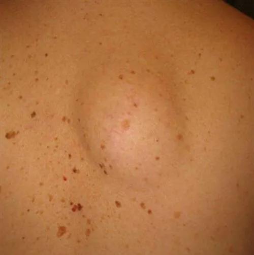 得了乙肝的人身上长红点怎么回事,乙肝病毒携带者身上有一颗颗红点