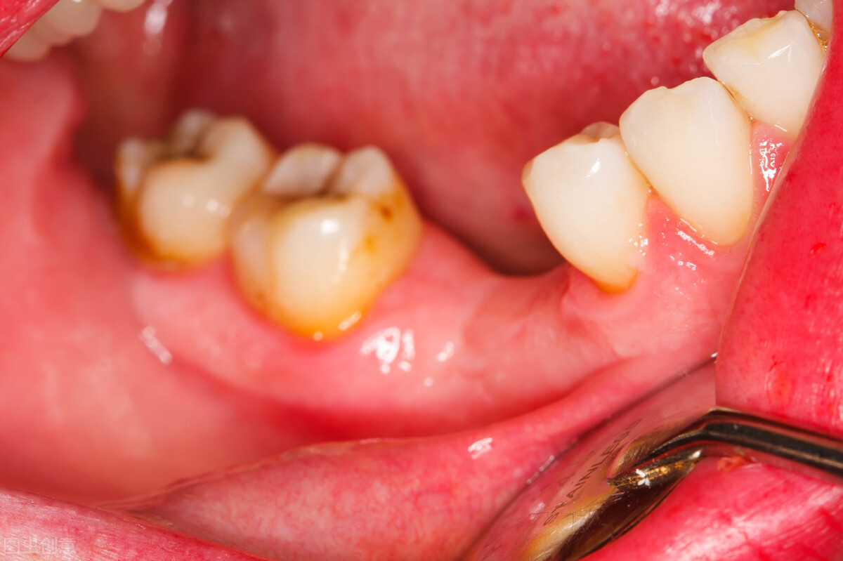 种完牙有黑三角怎么办,种植牙黑三角怎么处理