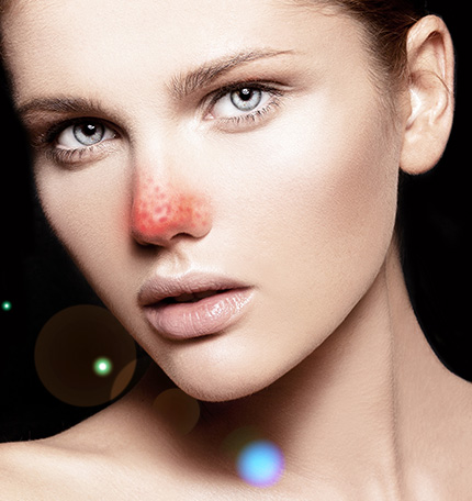 草莓鼻怎么去除有这5个方法就够?拯救草莓鼻,不要再用手去挤了