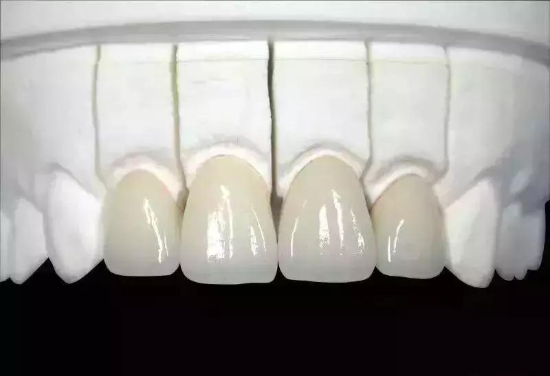 想配一副全瓷假牙要多少钱,做镍铬合金好还是钴铬烤瓷牙好