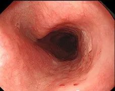 早期食管癌的病变范围是,早期食管癌手术费用多少