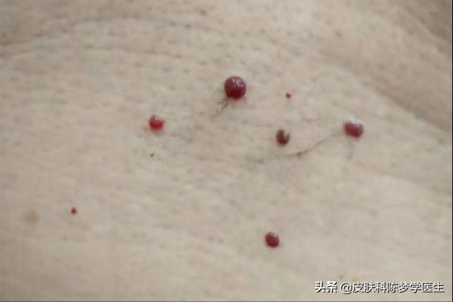 脖子上小肉球和丝状疣的区别,脖子上长了个细长的小肉球严重吗