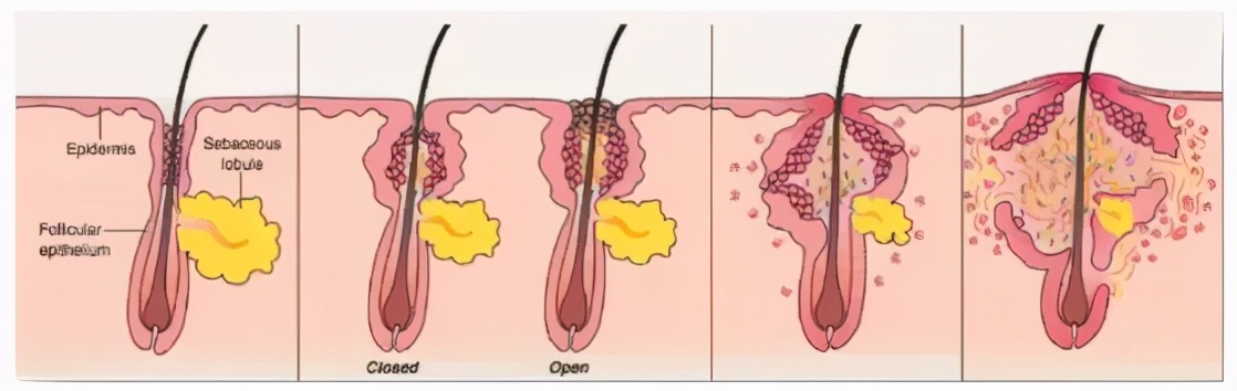 后背长痘最快最有效的方法,背部长痘的治疗方法