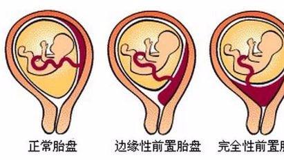 胎盘前置很危险孕妈千万要当心,完全性前置胎盘高危风险等级