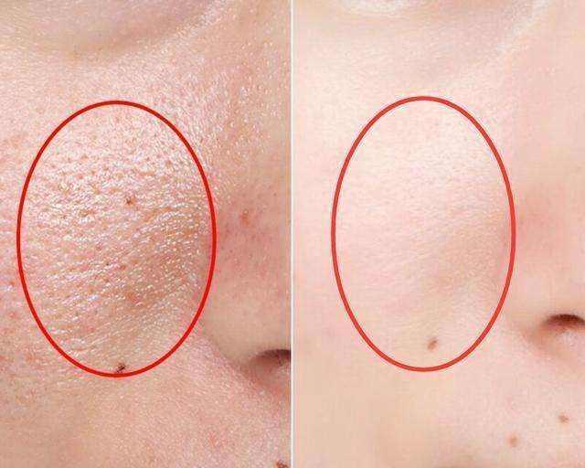 几种类型毛孔粗大改善的方法,毛孔粗大如何用科学方法改变