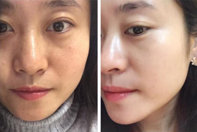 中国人去泰国打美白针,泰国美白针真实事件