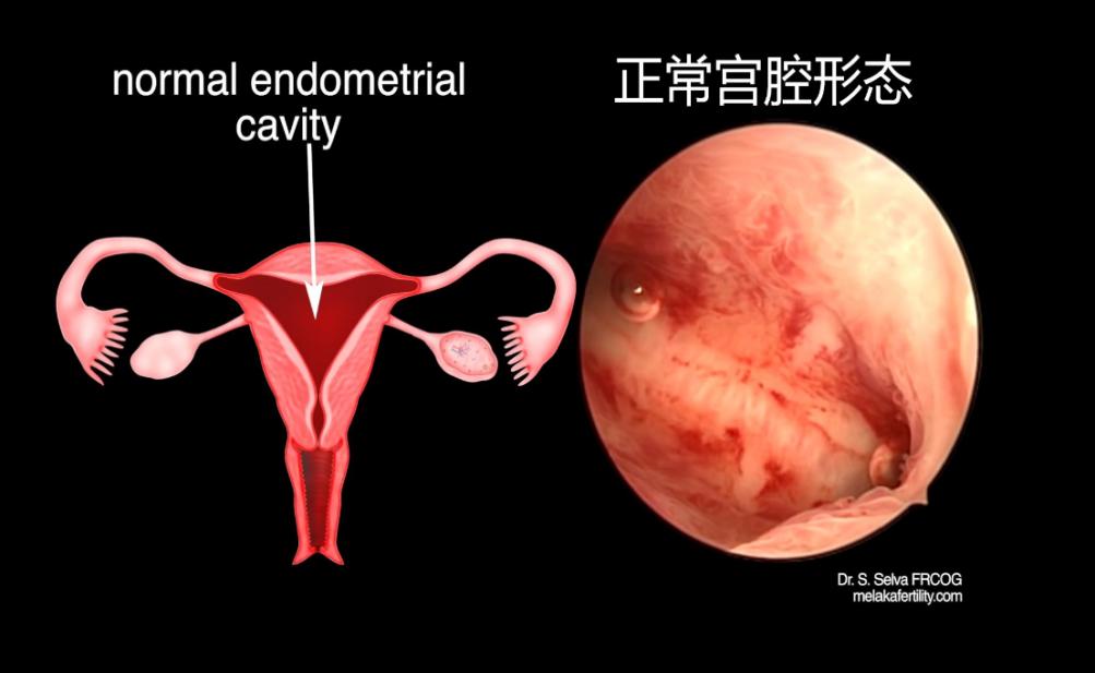 宫腔镜电切刀是什么样子,宫腔镜下正常的宫腔是什么样子