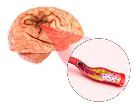 怎样预防脑梗死复发,如何预防脑梗死复发