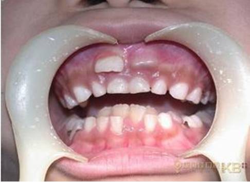 一个月宝宝口腔上颚白色的是什么,婴儿口腔上颚有一个小米样的白点