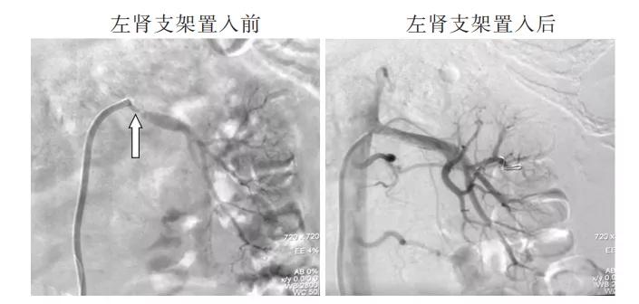 血肌酐118可以降到正常吗,肌酐136肾功能损伤严重吗