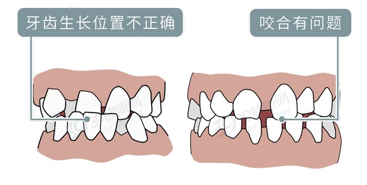 隐形牙套能矫正整齐吗,为什么戴牙套会让人变好看