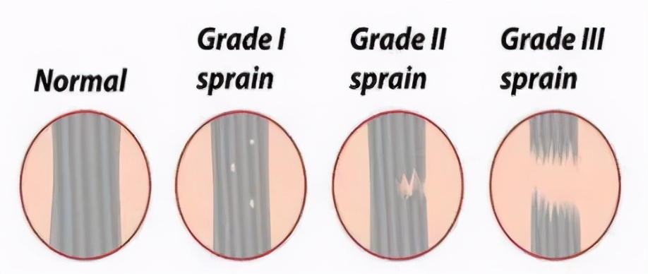 跟腱断裂康复的几个阶段,跟腱断裂手术三周跟腱恢复情况