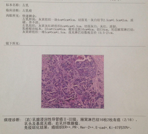 肿瘤病理报告怎么看,肿瘤怎样看病理报告