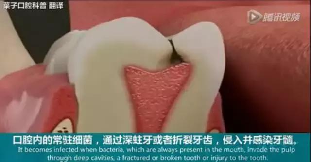 牙龈反复鼓包流脓是牙齿坏了吗,一上火牙龈就鼓包