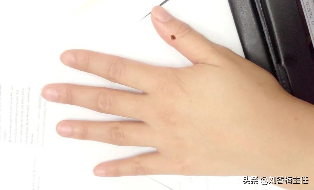 黑痣要不要去除,黑痣切除医生说需要做病理