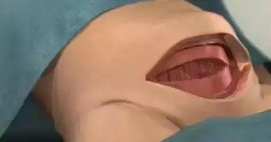 剖腹产需要剖开7层还是8层,剖腹产要切七层皮