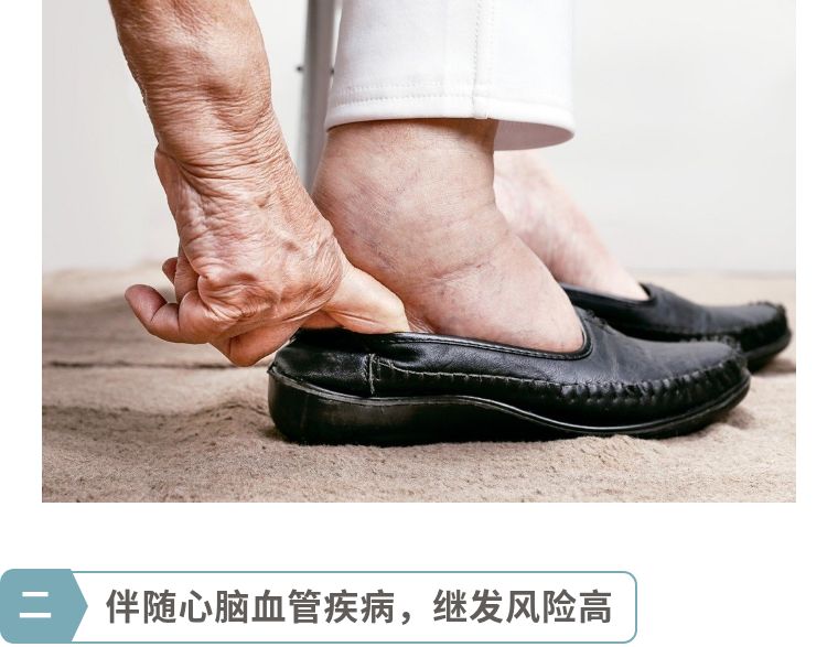 顽固静脉曲张千万别拖着,不痛不痒的静脉曲张可以不治吗