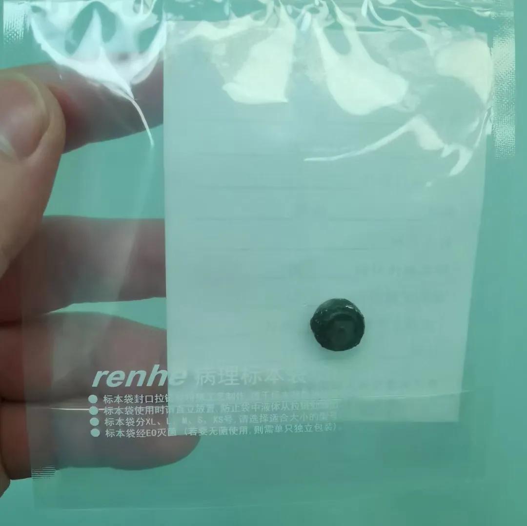 四岁小男孩往小丁丁里塞弹珠？那些年孩子塞进去的东西远不止这个