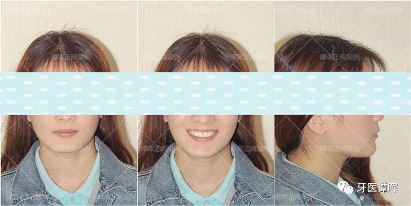 门牙前突牙齿不齐矫正案例分享,门牙和旁边牙齿不齐最快矫正方法