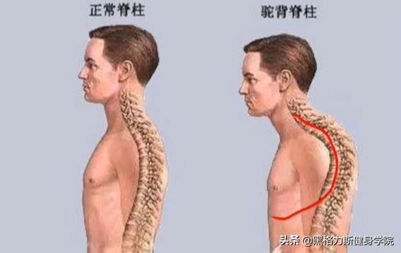 最有效果驼背矫正方法每天10分钟,最实用的二十多种驼背的矫正方法