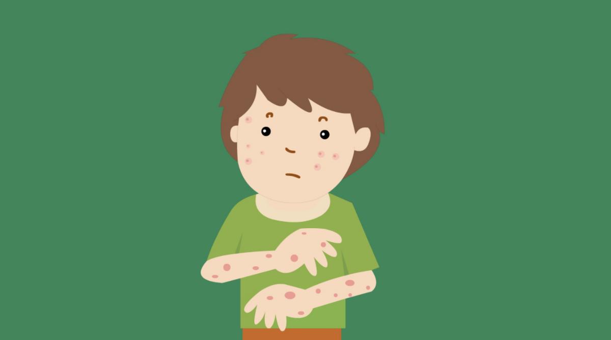 什么是过敏性紫癜有什么症状,什么是过敏性紫癜的表现