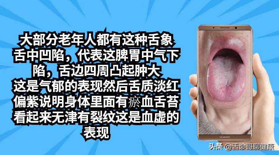 舌诊哥舌象分析阳虚体质,舌诊歌舌象分析和感悟