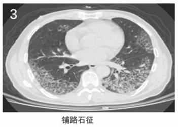 新冠肺炎胸片影像学表现有哪些,新冠肺炎患者轻微症状肺部ct表现