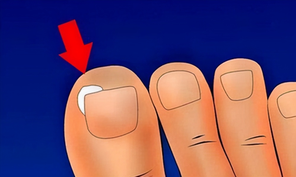 脚趾甲长进肉里会痛怎么办甲沟炎,脚趾甲老往肉里钻一碰还疼