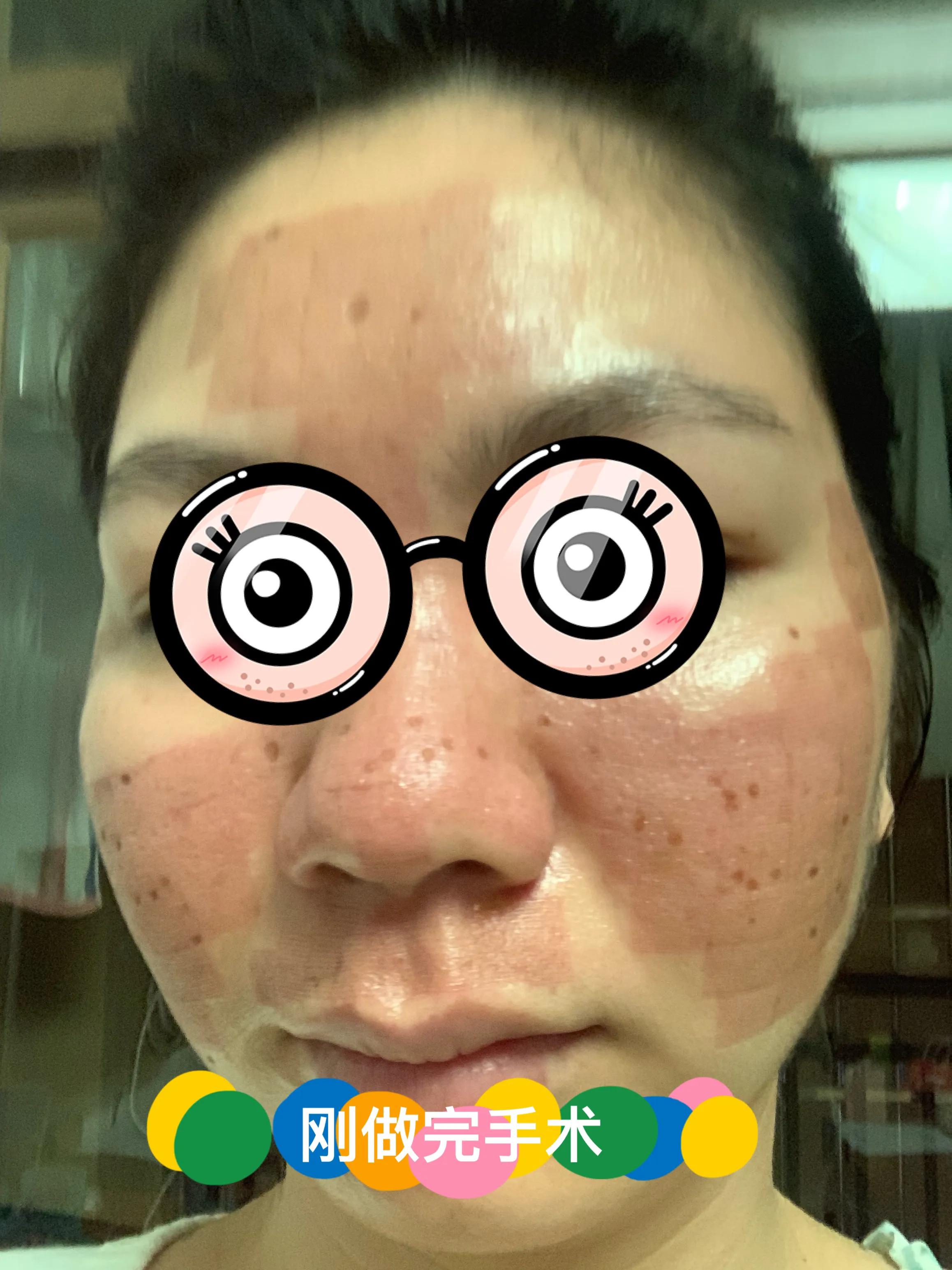 我的祛痘全过程,我的激光祛斑历程