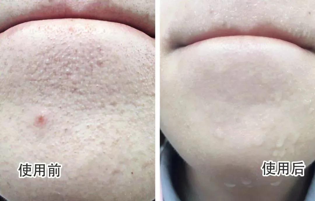 去角质慕斯可以去除死皮么,去角质慕斯去不去死皮