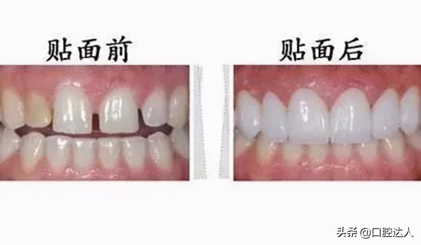 不吃糖按时刷牙为什么牙齿还会坏,为什么都按时刷牙了牙齿还那么黄