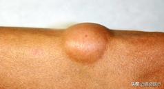 身上有个肿瘤要切除吗,怀疑其他部位有肿瘤需要怎么检查