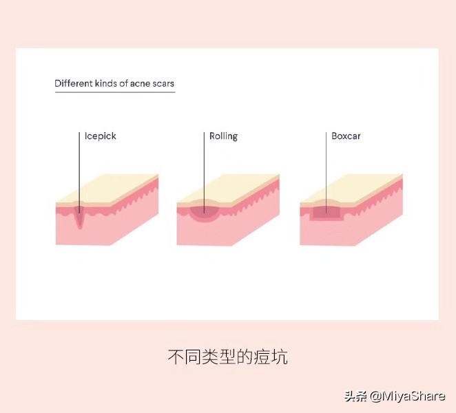 脸上痘坑痘印用什么方法修复,满脸痘坑疤痕怎么去除