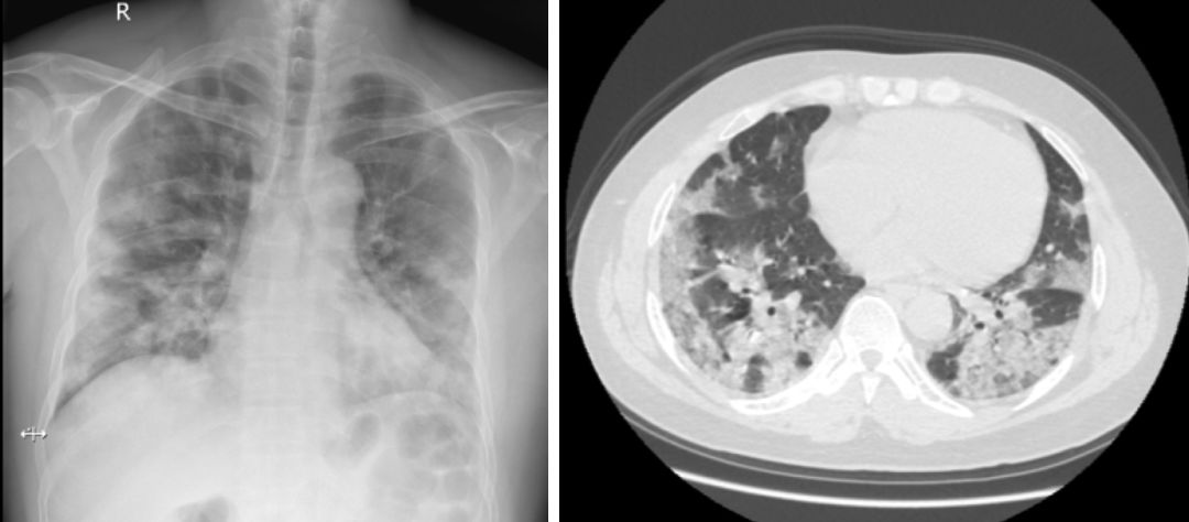 金葡菌感染肺炎能自愈吗,流感病毒诊断的金标准