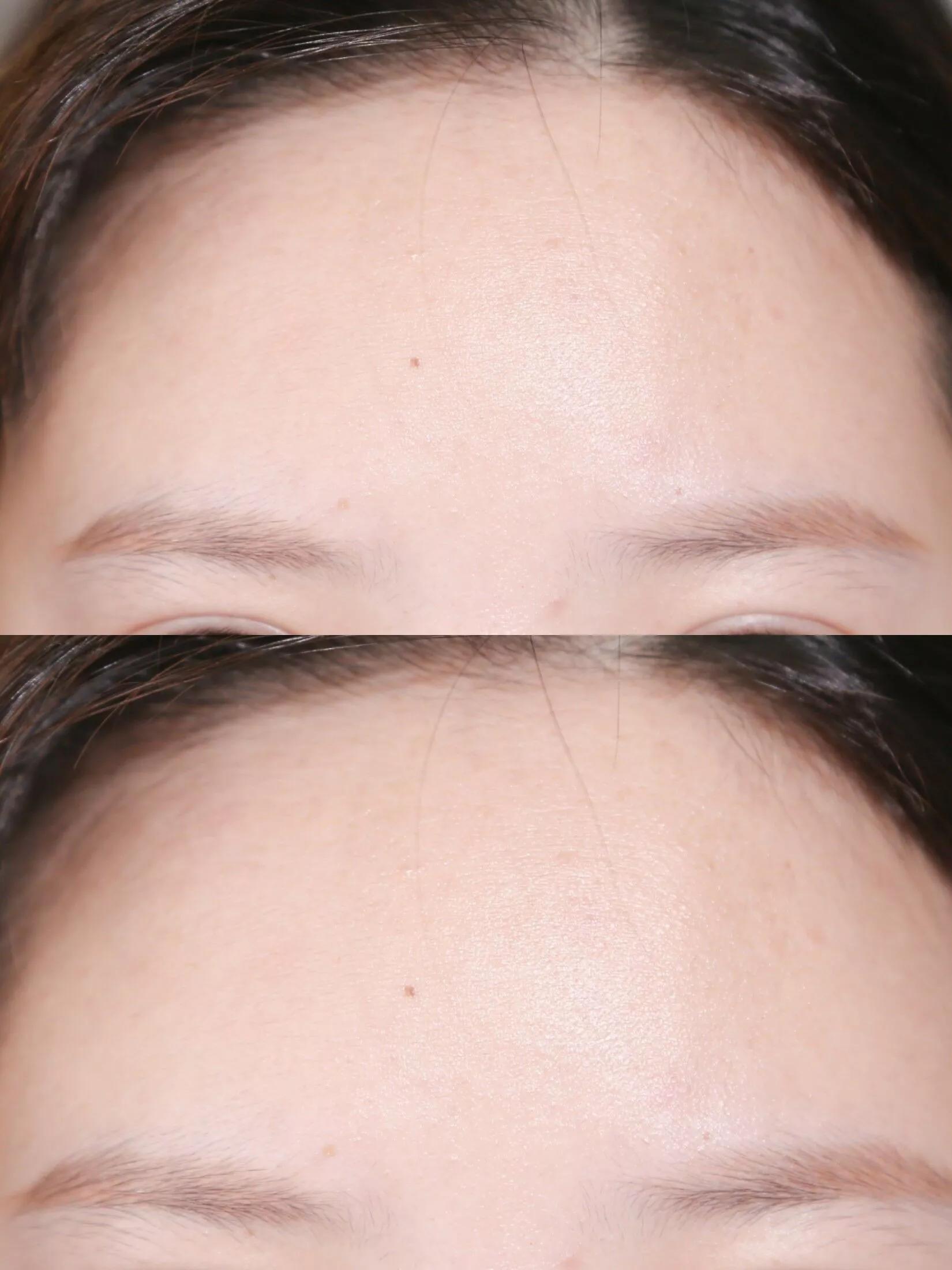 额头痘印全没了！看我如何内调外养祛痘印