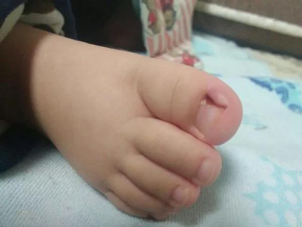 宝宝脚趾甲长到肉里怎么办,宝宝的脚趾总是弯着