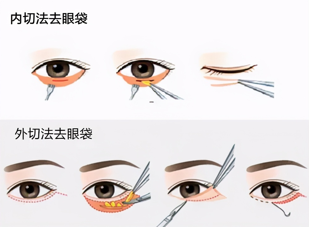 眼袋是怎么造成的怎么可以去眼袋,眼袋是怎么形成的怎么治疗效果好