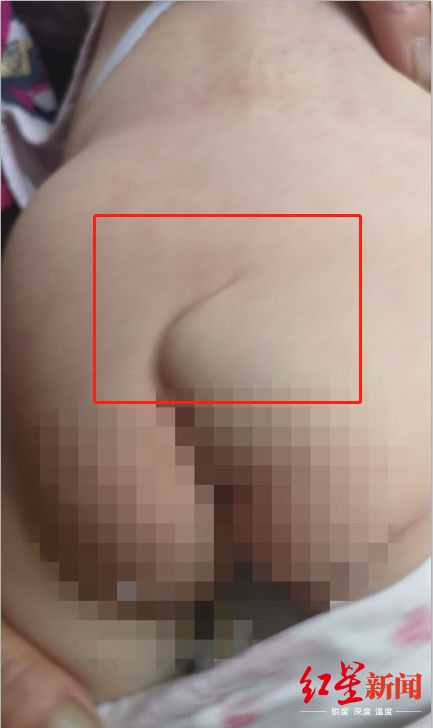 孕妇检查出双胞胎却生下五胞胎,孕妇检查30多次出生宝宝畸形