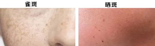 延安医院看脸上的雀斑和晒斑如何,雀斑和晒斑怎么区别