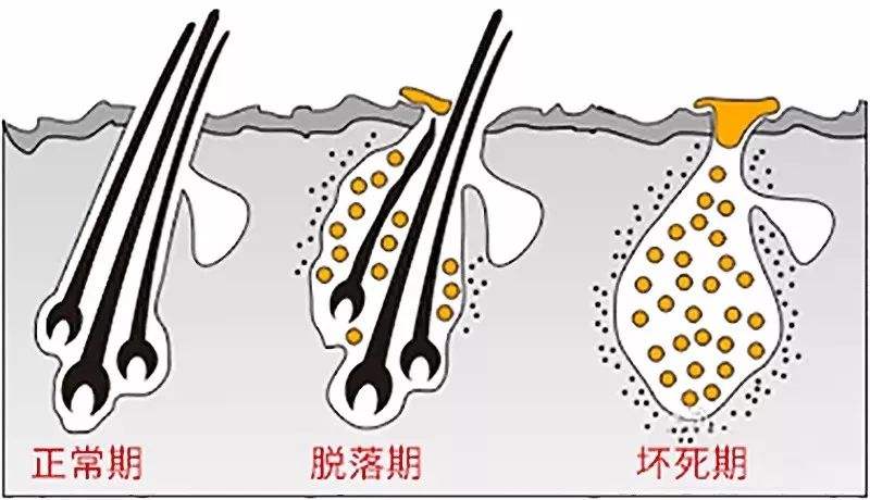脱发毛囊没闭合怎么治疗,脱发毛囊闭合怎么办