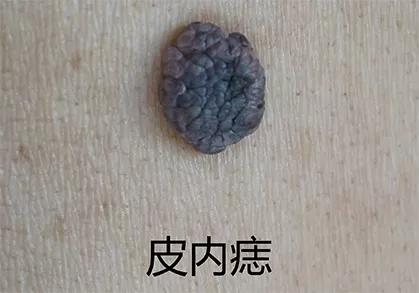 痣能点吗,我的痣凸起来会癌变吗