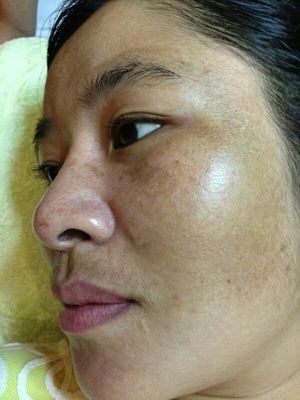 铅汞脸如何自救,那些被毁容的女孩