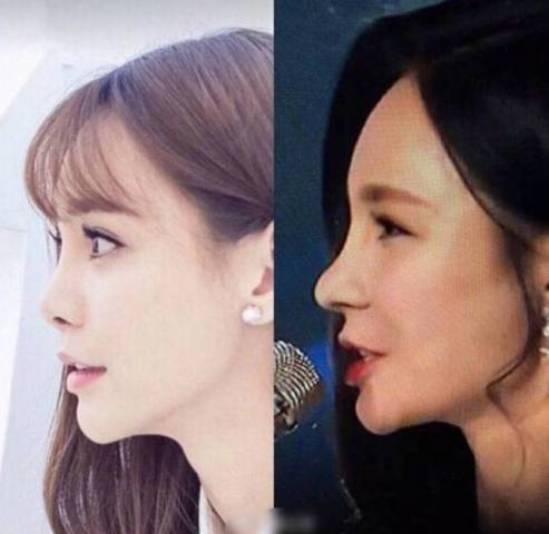 盘点一些有问题的鼻子,明星都没整好的鼻子