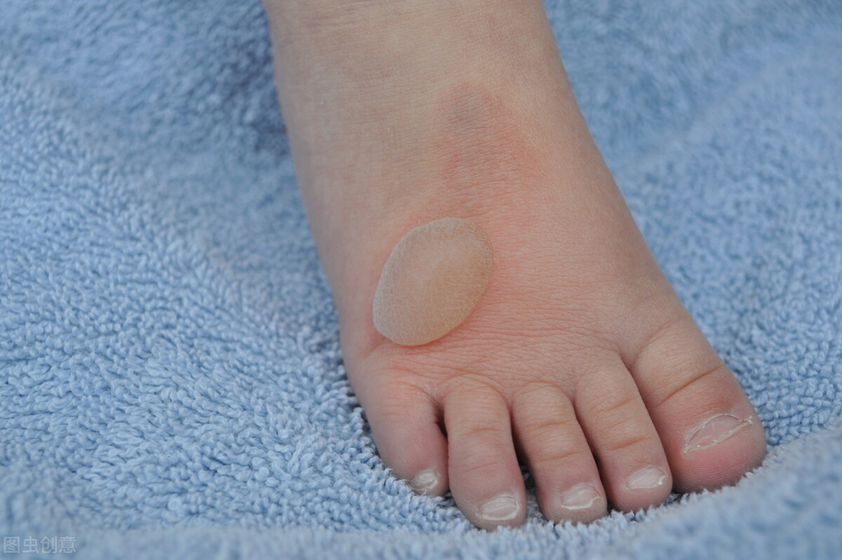 开水烫伤用什么涂一涂,香油兑石灰粉治疗烫伤过程