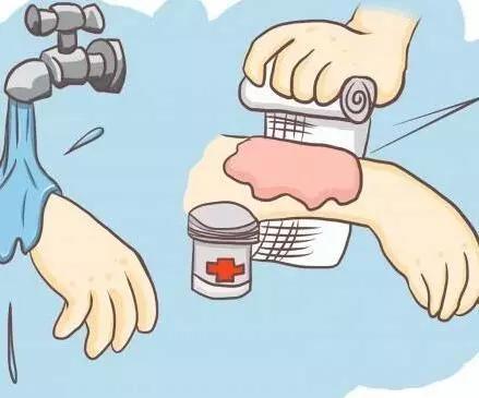 烫伤止痛最快的方法是牙膏,烫伤一直火辣辣的疼用牙膏可以吗