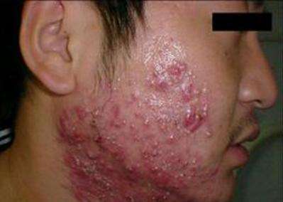 痘痘感染后愈合形成痘坑,痘痘反反复复就是不彻底该怎么办