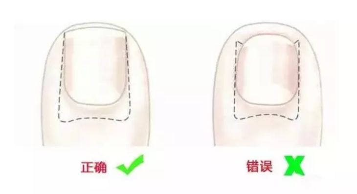 宝宝脚趾甲往肉里长怎么剪,宝宝脚趾甲长到肉里怎么办