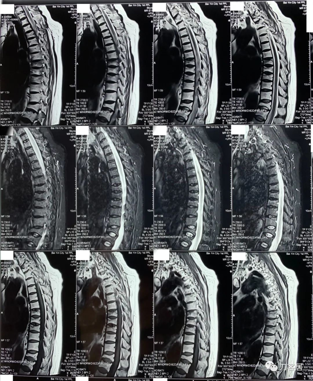 脊柱骨质疏松性压缩性骨折,老年骨质疏松压缩性骨折诊治